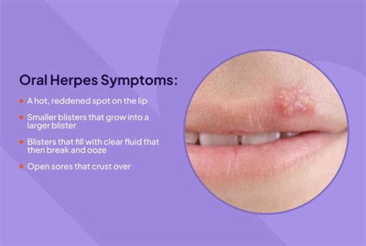 
What’s Wrong With Colby Covington Teeth? Herpes Symptoms, Diagnosis And Treatment 